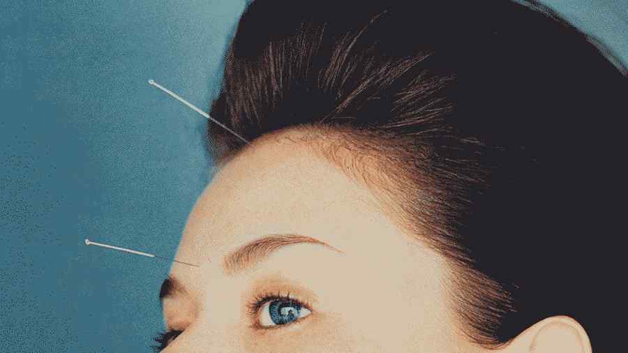 5 benefícios de beleza surpreendentes da acupuntura